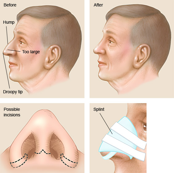 Rhinoplasty